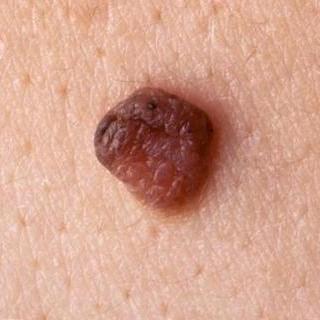 Mole Treatment - Rhode Dermatology