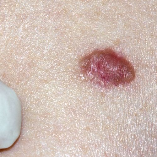 Basal Cell Carcinoma