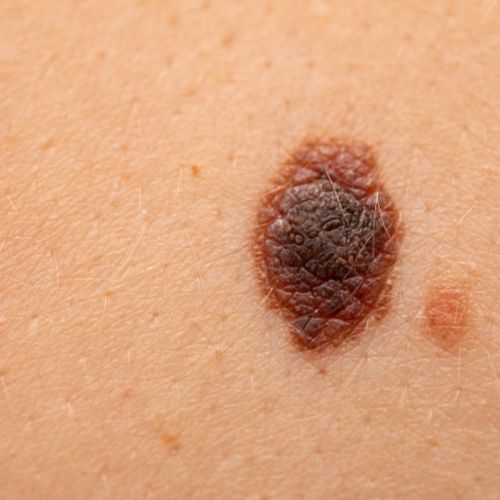 Melanoma