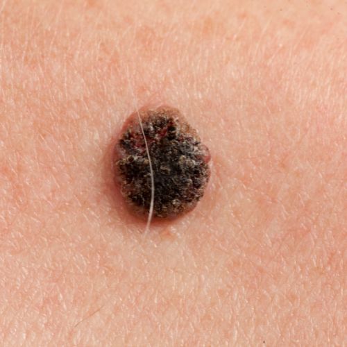 Squamous Cell Carcinoma