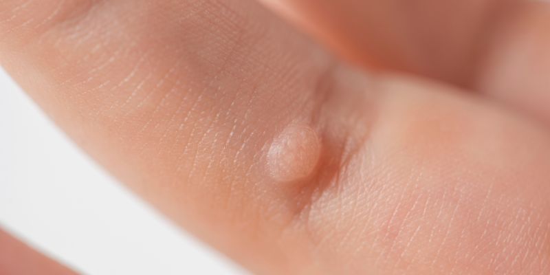 Wart treatments RI