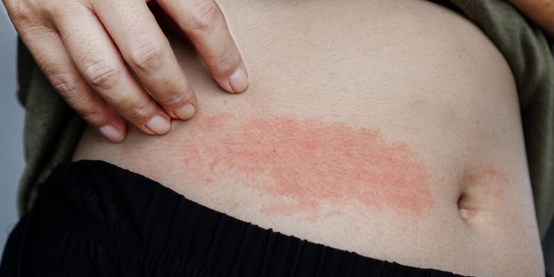 rash treatments RI