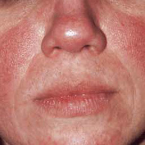 rosacea