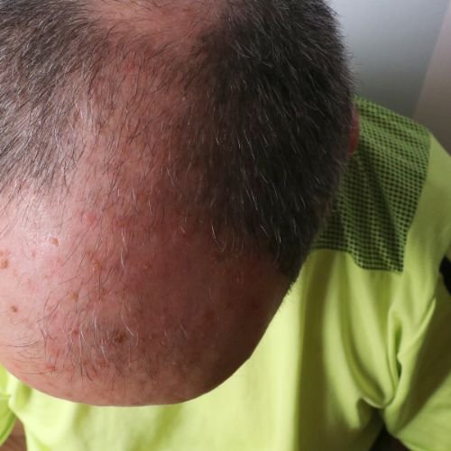 Actinic Keratosis treatment