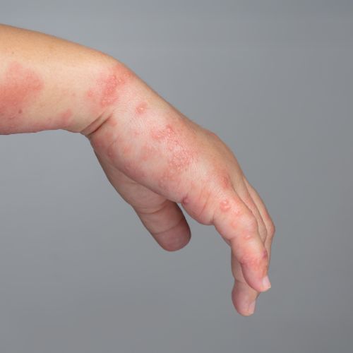 Shingles treatment