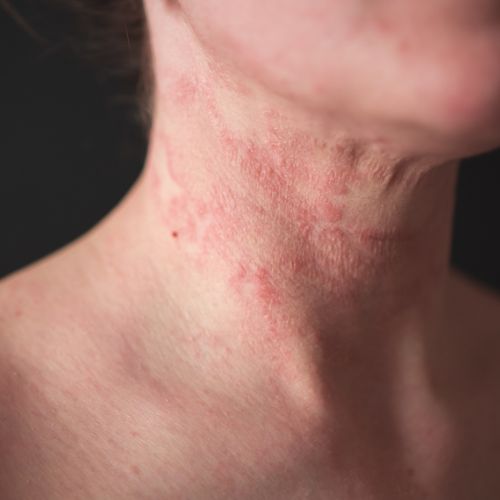 contact dermatitis treatment